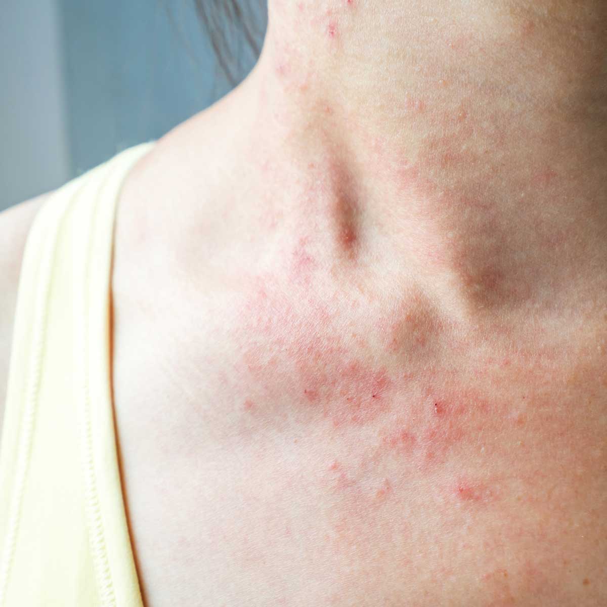 skin rash treatment